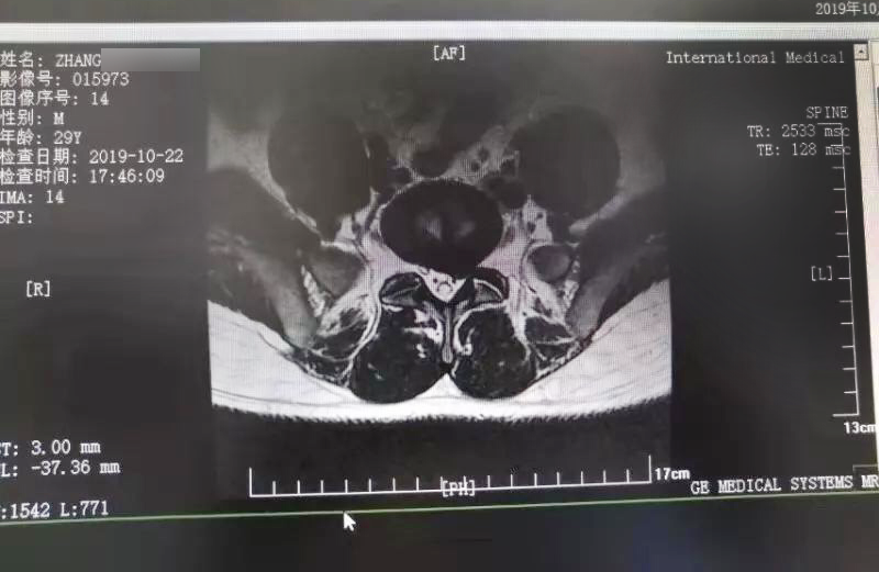 三秦網(wǎng)報道—西安國際醫(yī)學(xué)中心骨科醫(yī)院成功完成首例椎間孔鏡手術(shù)