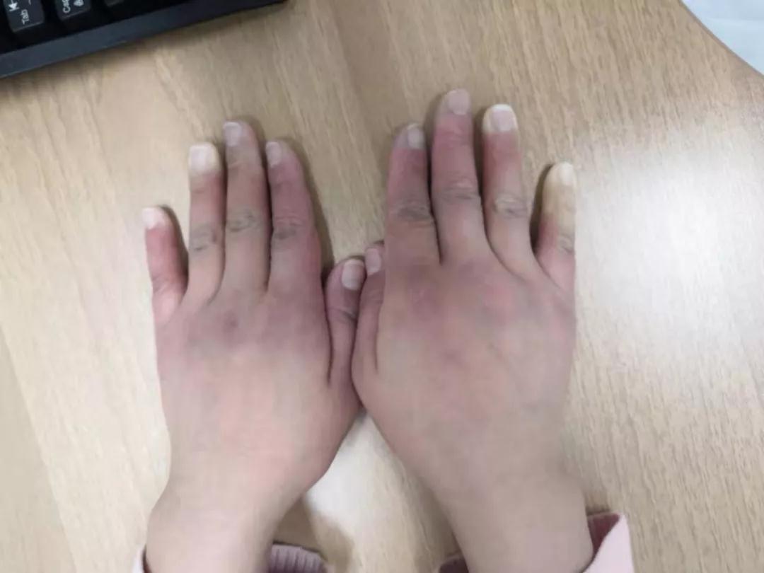 “手指、腳趾發(fā)白、發(fā)紫……”這些“小毛病”千萬別大意