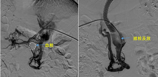 血栓攔路，如何破局——罕見巨大門靜脈血栓TIPS手術(shù)實錄