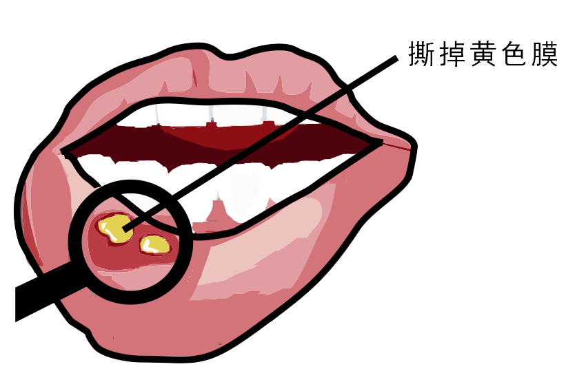 經(jīng)常口腔潰瘍，真的只是缺維生素嗎？