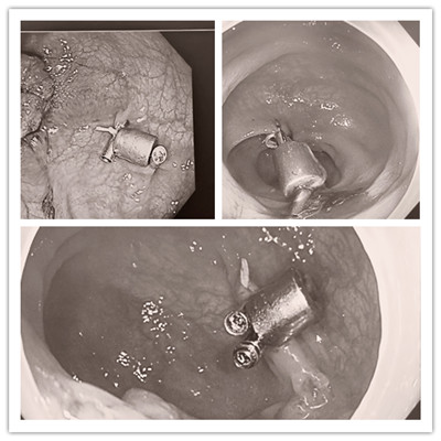 消化病醫(yī)院內(nèi)外科聯(lián)合開展3例“磁環(huán)預(yù)標(biāo)記輔助腹腔鏡結(jié)、直腸癌根治術(shù)”