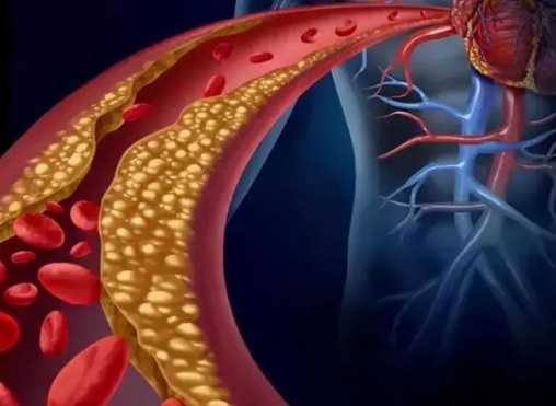 警惕！冠脈支架術(shù)后這些誤區(qū)千萬別踩，趕緊收藏！