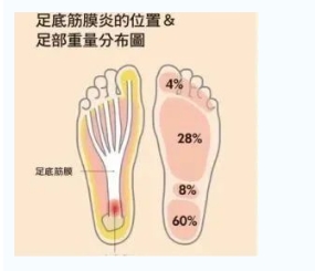 每年新生數(shù)百萬足底筋膜炎患者！國際醫(yī)學(xué)專家提醒：跑步要選擇合適的鞋
