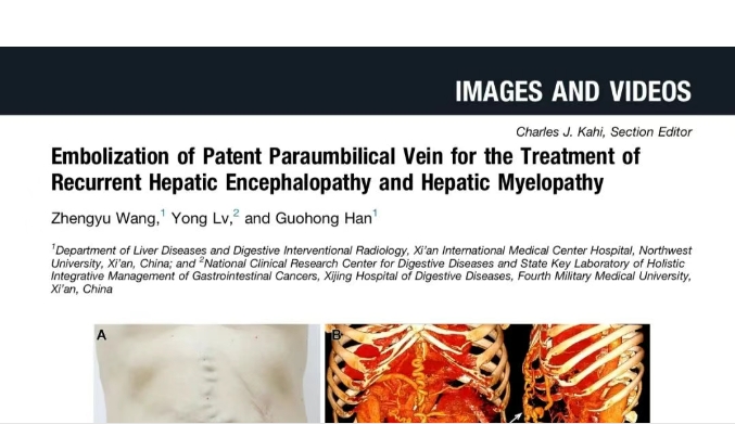 我院護(hù)理團(tuán)隊(duì)臨床成果登榜國際肝病權(quán)威期刊，影響因子11.6