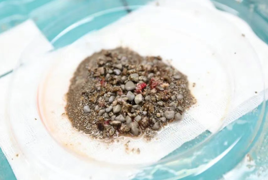 密集恐懼癥慎入！男子腎臟里取出上萬(wàn)顆沙石