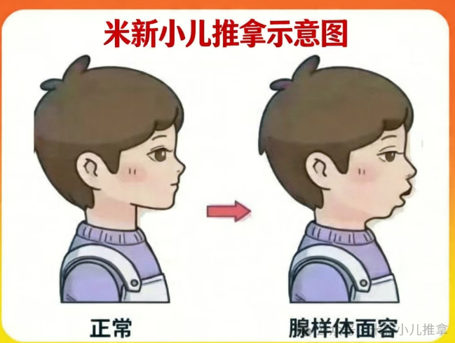 兒童腺樣體肥大只能手術(shù)？不，一位媽媽的親身經(jīng)歷給出另一種答案